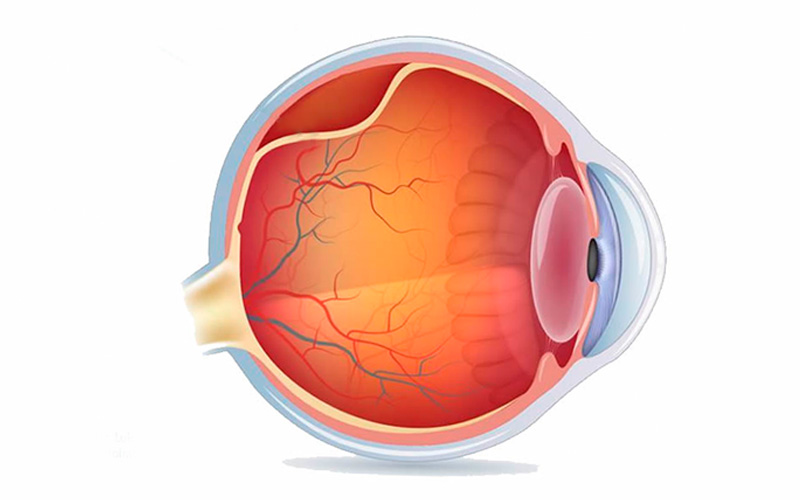 O que é o descolamento da retina?